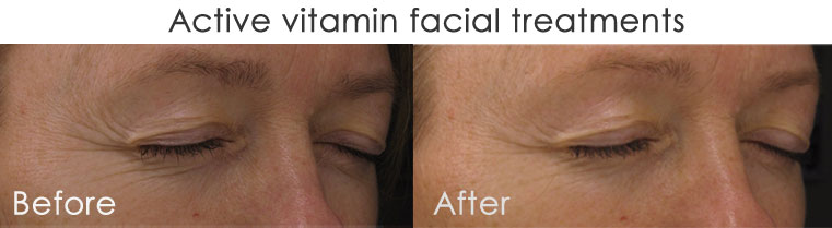 pigmentation-treatments