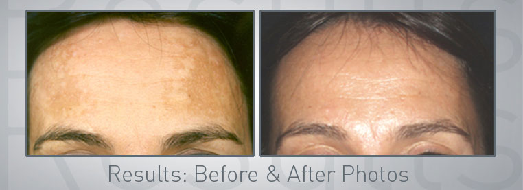 pigmentation-treatments